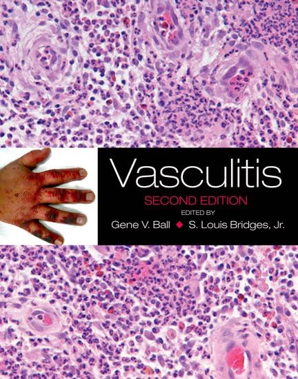 Vasculitis